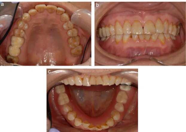 Fig. 8 – (a)–(c) Intraoral photographs of the patient after prosthetic treatment.