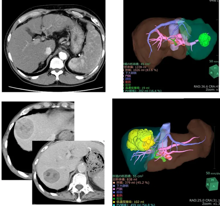 Fig 5. (A) Representative cases in the validation set. Abdominal enhanced computed tomography (CT) shows a very large tumor in the right lobe