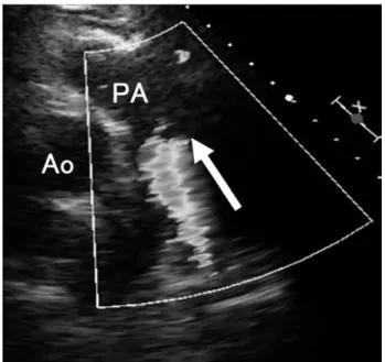 Fig． ３ Preoperative computed tomography revealed pulmonary artery was compressed by huge saclar aneurysm of distal arch （３ D image） and indicated the continuity between aorta and pulmonary artery（coronal &amp; sagittal view, allows）