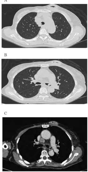 Fig． ３ PET-CT：左主気管支内に SUVmax ３． ２の FDG 集積亢進を 認めたほか，鎖骨上窩リンパ節，縦隔リンパ節，右肺門部 リンパ節にも集積を認めた。