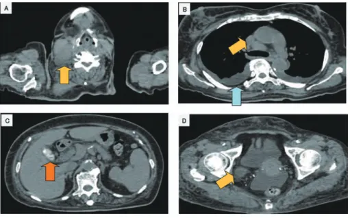 Fig． １ 入院時 CT 頚部，縦隔，骨盤内にリンパ節腫脹を認めた（黄色矢印） 。胆石（橙色矢印） ，胸水（青色 矢印） ，腹水，脾腫もみられた。 Fig． ２ 病理学的検査（右頚部リンパ節） 大型の異型リンパ球がびまん性に増殖しており（A，B） ，免疫染色では CD ２ ０陰性（C） ，CD ７ ９ α 陽性（D） ，CD １ ０陰性（E） ，CD ３は介在する正常リンパ球のみに陽性（F） ，CD ３ ０陽性 （G） ，ALK 陰性（H）であった。 （A×１ ０ ０，B-H×４ ０ ０）CD２０陰性DL