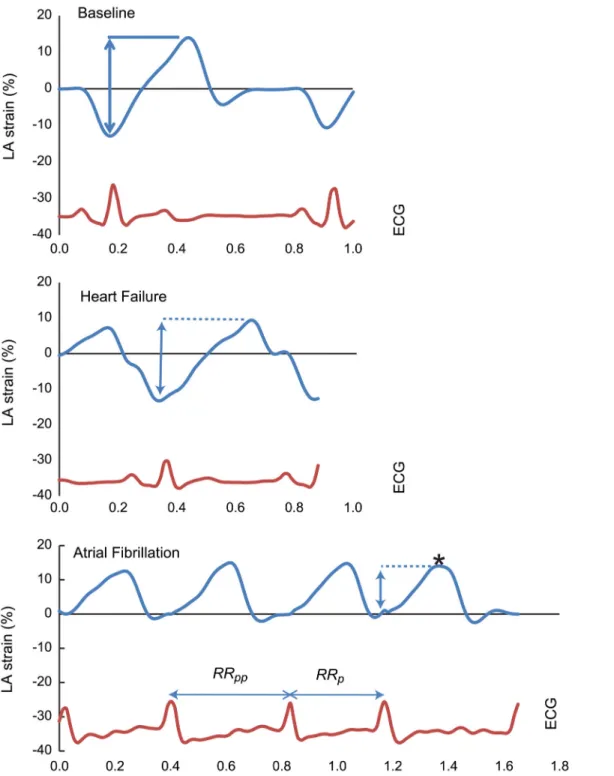 Fig 1. A representative example of left atrial (LA) strain obtained at baseline, after heart failure development with the animal in normal sinus rhythm, and after subsequent atrial fibrilation induction in a same single animal from vagal nerve stimulation 