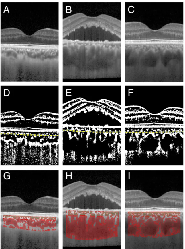 Fig 1. Spectral domain optical coherence tomographic (SD-OCT) images of an eye with central serous