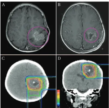 Fig. 1  (a) 3-year-old boy had a parietal lobe tumor.  (b) Tumor excision was performed and was diagnosed  as an anaplastic ependymoma