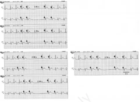 Figure  1.  Holter  recording  on  day  seven  displaying  sinus  arrest  with  P  wave  (arrow) falling off, and 2.94 seconds at the greatest R-R interval