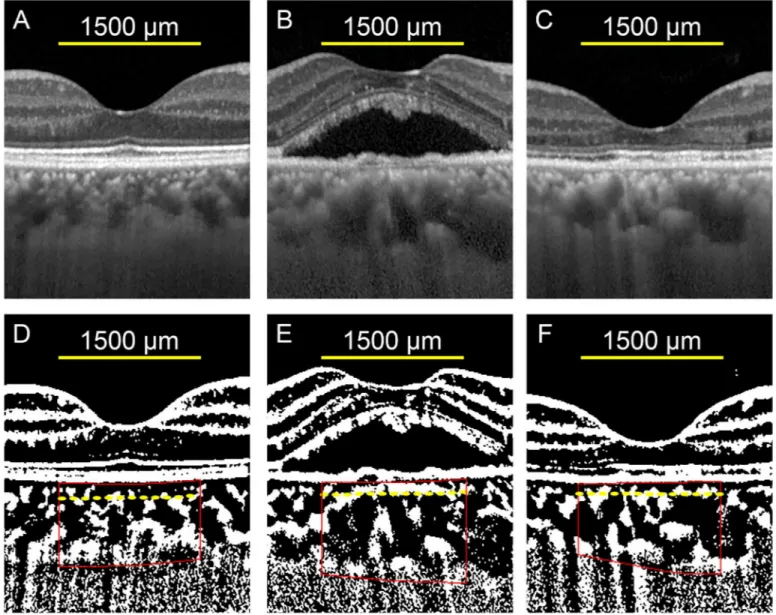 Fig 1. Representative enhanced depth imaging optical coherence tomographic (EDI-OCT) images and the converted binary images of the eye of a 55-year-old man with central serous chorioretinopathy (CSC)