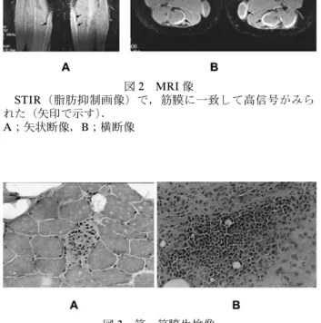 図 4 TRAPS 患者の臨床経過と血清中の TNFa，可溶性 TNFRSF1A，可溶性 TNFRSF1B の経過