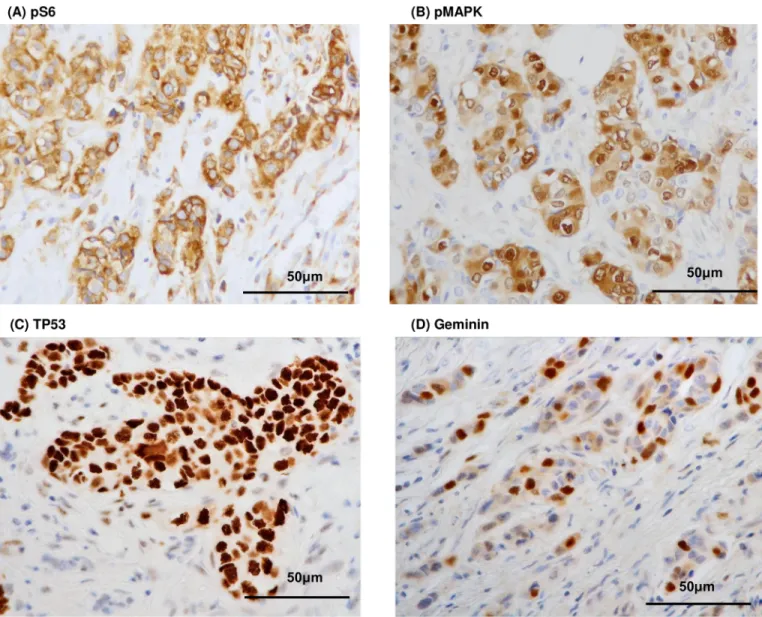 Fig 1. Representative positive immunostaining for pS6 (A), pMAPK (B), TP53 (C) and geminin (D)