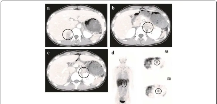 Fig. 1 Contrast-enhanced CT showed enhanced masses in the right adrenal gland (a), left adrenal gland (b), and left renal hilus (c)