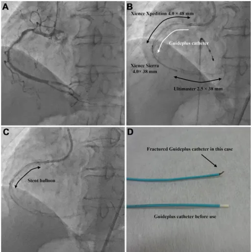 Figure   1.   Entrapment and subsequent fracture of the guide extension catheter. A: A diagnostic angiogra- angiogra-phy showed the diffuse 75% lesion from the proximal to middle RCA segment and 90% lesion in the distal  RCA segment with severe calcificati