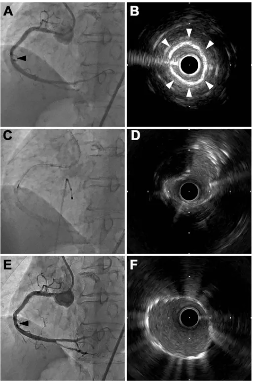 Figure   2.   The procedures after leaving the tip of the guide extension catheter. A, B: Angiography showed  a stenosis at the Guideplus tip in the middle RCA