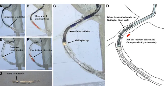Figure   5.   Anchoring guide extension catheter method in vitro. A: A Guideplus was entrapped in the middle RCA