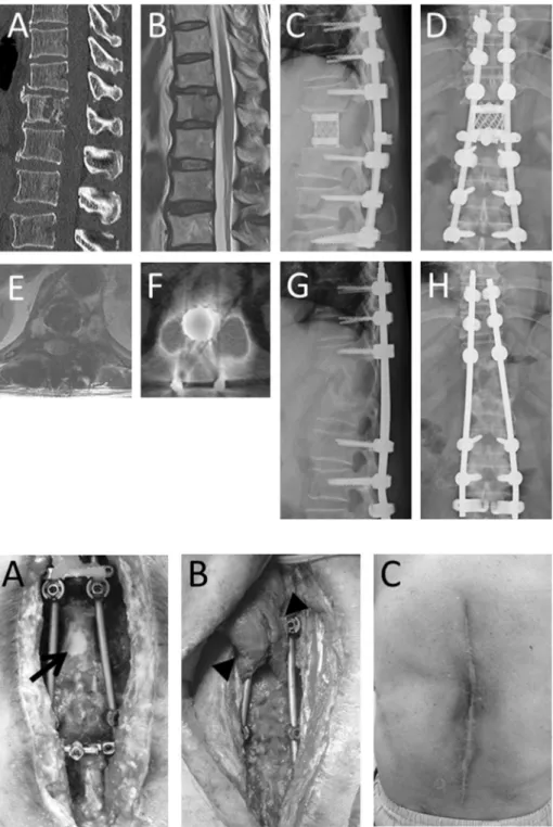 Fig. 1. Pre- and postoperative images. Preoperative multi- multi-planner reconstruction sagittal image of computed  tomo-graphy revealed osteolytic lesion at 12th thoracic vertebra (A)