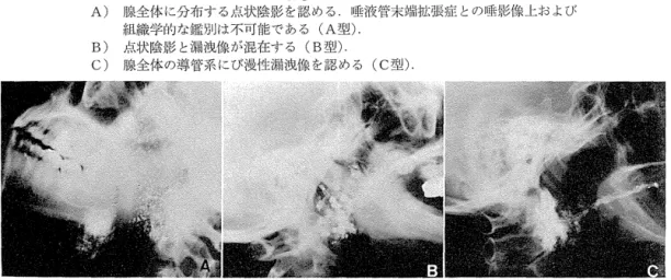 図 3 Sj δgr en 症候群の唾影像