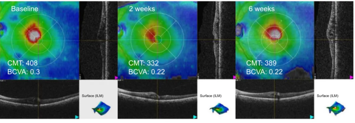 Figure 1 Optical coherence tomography scans in a case of branch retinal vein occlusion (eye 2).