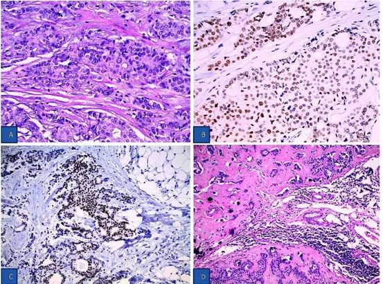 Figure 4. Histopathological findings of invasive ductal breast carcinoma. (A) Tumor cells are medium in size with weakly eosinophilic  cytoplasm and include oval slightly irregular nuclei with granular chromatin small nucleus and moderate pleomorphism and 