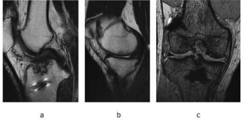 Figure 2  Preoperative MRI of the right knee