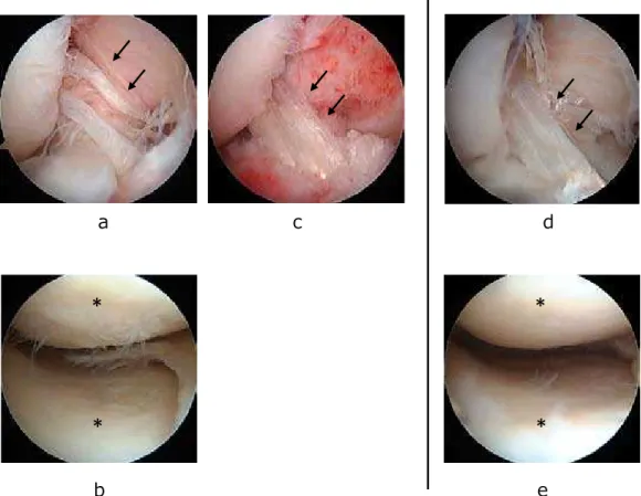 Figure 3  Arthroscopic  ﬁndings of the right knee: a, b, c, at simultaneous HTO and revision ACLR; d, e, 