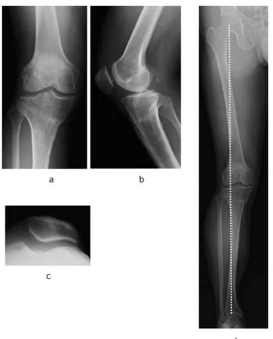 Figure 5  X-ray three years after operation