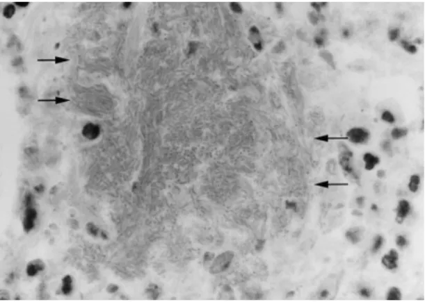 Fig 3. Microscopic examination revealed nests (arrows) of gram- gram-negative rods.
