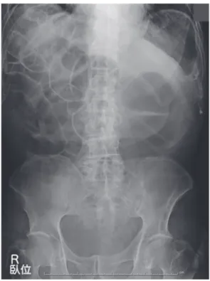 Figure 1　Abdominal X-ray film X-ray showed an extended intestine.