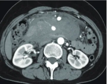 Figure 3　 An image of contrast-enhanced axial CT scan in  the early phase CASE 2