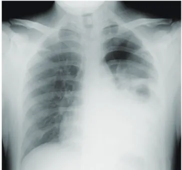 Figure 3　An abnormal vessel of the chest wall was found  during operation （arrow）