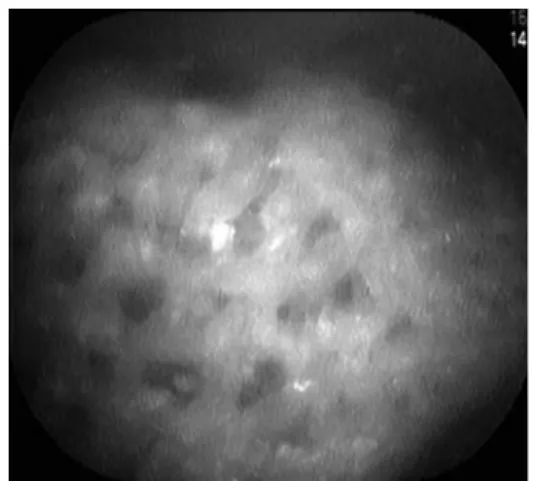 Fig. 1. We detected a yellow brown foreign body in the bladder.