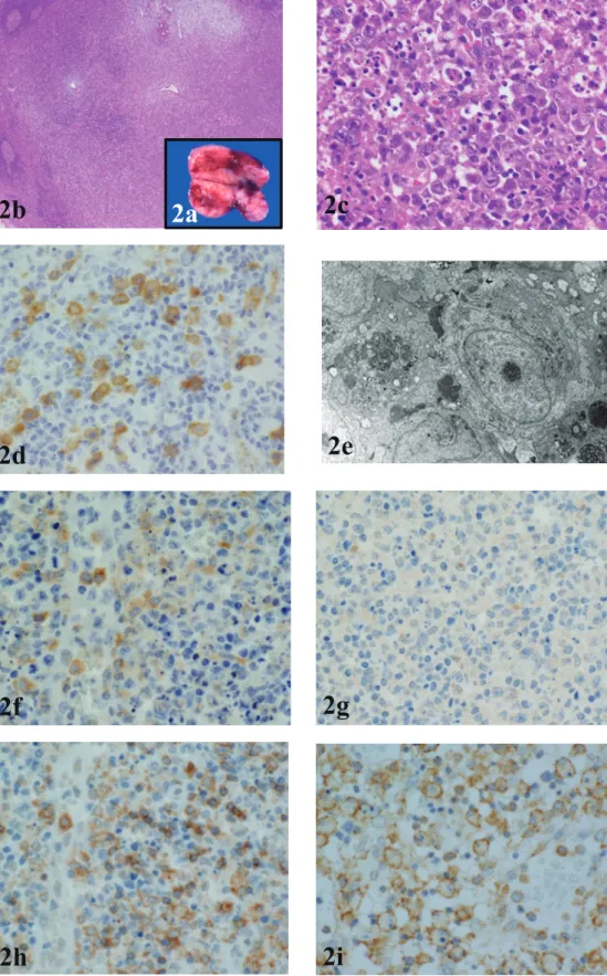 Fig. 2.  Characteristic histological features of NEL: (a) Macroscopic cut surface of the affected lymph node shows soft and patchy  hemorrhagic lesions
