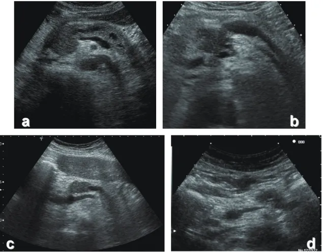 Fig. 1A  【浸潤性膵管癌（ invasive ductal carcinoma ）】経腹壁超音波検査（ US ） a  膵頭部に輪郭が明瞭で一部で不正な低エコー腫瘍を認める．腫瘍尾側主膵管に拡張が認められる． b  膵頭 部に輪郭が明瞭で不整な低エコー腫瘍を認める．腫瘍内部には一部にやや高エコー領域を認める．腫瘍尾側 主膵管に拡張が認められる． c  膵体部に輪郭が明瞭で一部で不整な低エコー腫瘍を認める．腫瘍尾側主膵管 に拡張が認められる． d  膵体部に輪郭が明瞭で不整な低エコー腫瘍を認める．腫瘍
