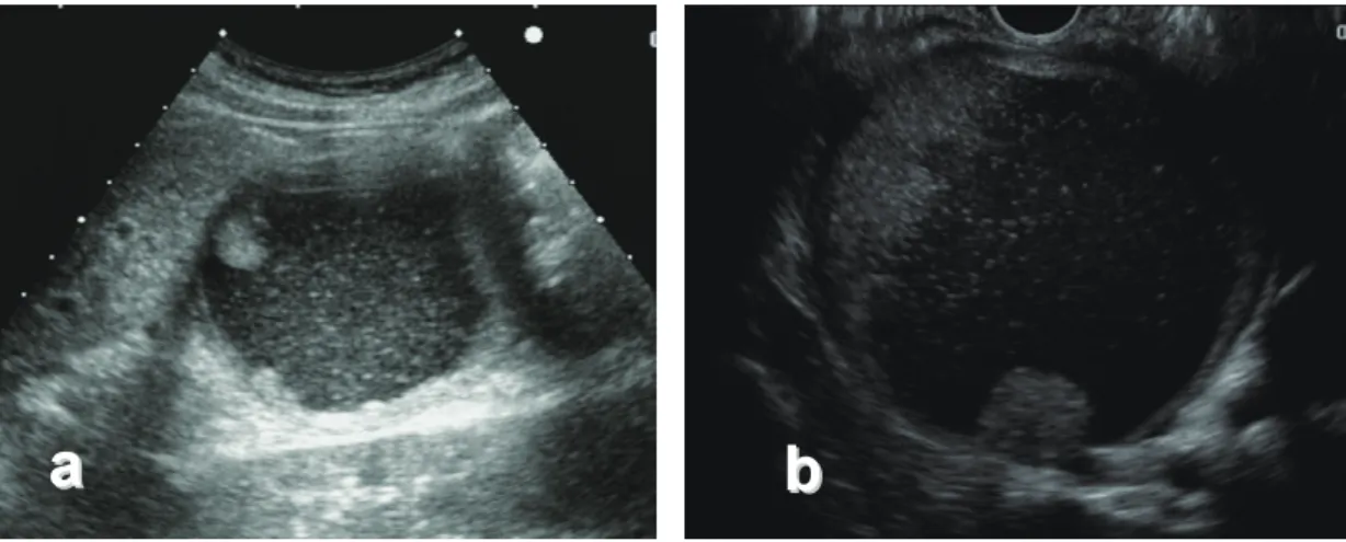 Fig. 6  【 mucinous cystic neoplasm: MCN 】経腹壁超音波検査（ US ），超音波内視鏡検査（ EUS ） a  膵尾部に単房性嚢胞性疾患を認める．嚢胞内エコーは細顆粒状を呈する．また，皮膜は厚く，壁には広 基性腫瘍像を認める． b  膵尾部に単房性嚢胞性疾患を認める．嚢胞内には細顆粒状部分と無エコー領域 を認める．広基性腫瘍はより明瞭に描出され，厚い皮膜もより明瞭化する．