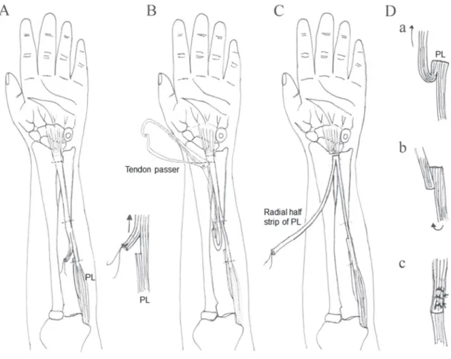Fig. 1 Surgical technique (1). The palmaris longus (PL) tendon is exposed and split into 2 halves at a distance  greater than 6 to 8 cm from the insertion point, which is enough to perform an interlacing suture to the  extensor mechanism around the metacar