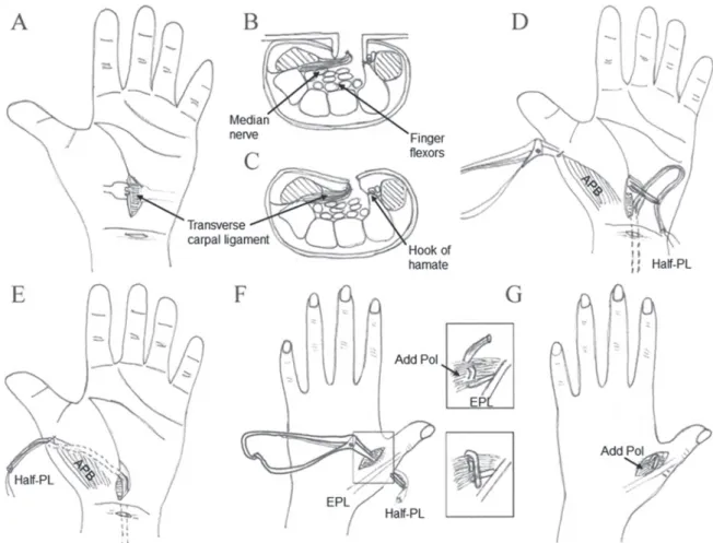 Fig. 2 Surgical technique (2). Mini-incision through a 1.0- to 1.5-cm incision is made over the palmer hand crease  (A)