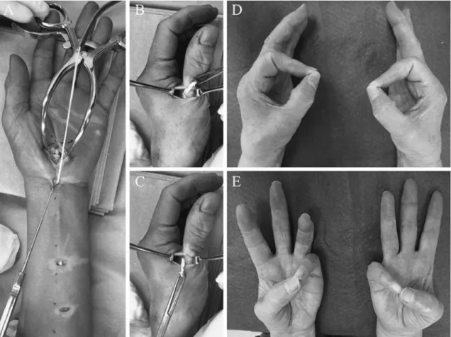 Fig. 3 Case presentation: a 67 year-old woman with severe atrophy of the left hand due to longstanding carpal  tunnel syndrome