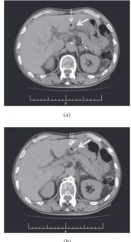 Figure 1a and 1b. Abdominal CT showing a linear high-density structure [solid arrows] in the angular region of the stomach surround by a small amount of air [dashed arrows] suggestive of perforation.