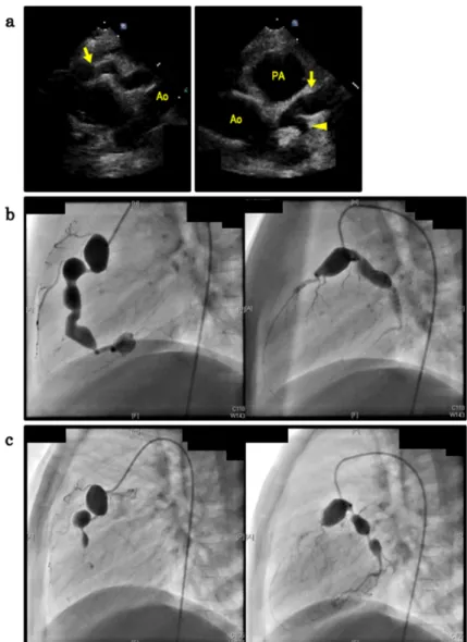 Fig.   1  (a) Echocardiography showing normal left ventricular ejection fraction and slight pericardial eﬀusion, with  dilatation of all the coronary arteries, as follows: the right coronary artery (RCA) 9.1 mm (Z score 12; the  arrow in left panel), the l