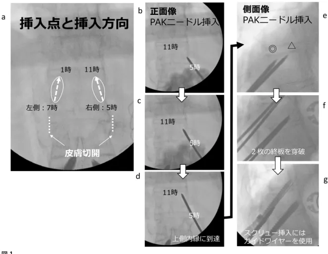 図 1 a：正面透視の TSD の挿入点と挿入方向． b：TSD 挿入点にある PAK ニードル先端． c：椎弓根内を進む PAK ニードル． d：PAK ニードルが椎弓根円の上側内縁に到達すると透視装置を側面像に変える． e：側面透視で PAK ニードル先端が椎体終板の後方 1/3 にあれば至適位置である． f：2 枚の椎体終板を穿破させる． g：ガイドワイヤーを用いてスクリューを挿入する．ዠোਡधዠো্਱కડ؟ৎৎৎంડ؟ৎຜჹજ৫ ৎৎਫએ൸ 3$.ॽشॻঝዠোৎৎৎৎ ঱ડ৔໿पง୸ ડએ൸ 3$.