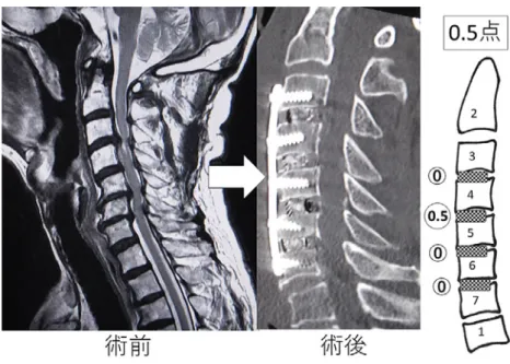 図 5 C5 麻痺を生じなかった症例 C3/4/5/6/7 を椎間除圧した．除圧組み合わせスコアは 0＋0.5＋0＋0＝0.5 点． 術後 C5 麻痺を生じなかった． 図 6 C5 麻痺を生じた症例 C3/4/5/6/7 を C4・C5・C6 の 3 椎体亜全摘で除圧した．除圧組み合わせスコアは 1＋1＋0.5 ＝2.5 点．術後 C5 麻痺を発症した．C4/5 高位での硬膜は前方に 9 mm 拡大し，固定部分は 術後 6 mm の短縮を認めていた． C5 麻痺発症に関する椎体亜全摘と椎間除圧 の違い 今回