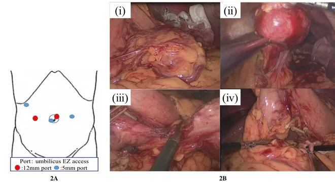 Fig. 2. Port placement and intraoperative images. A Port placement. B- (i) The tumor was covered with greater omentum.