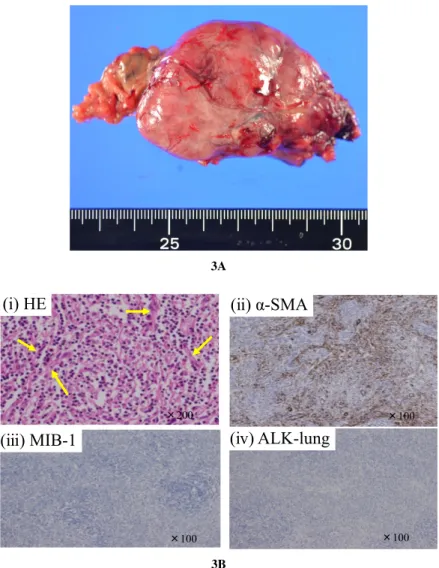 Fig. 3. Macroscopic and microscopic findings of the tumor. A. Macroscopically, the tumor was solitary and measured 55 × 45 × 25 mm
