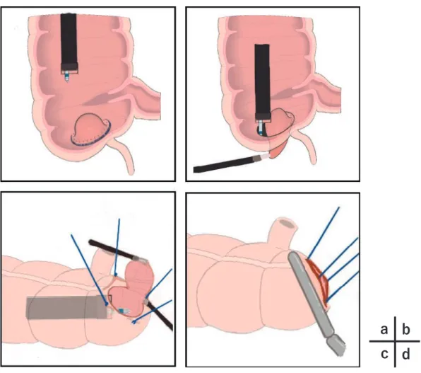 Figure   1.   The procedure of laparoscopy and endoscopy cooperative surgery for colorectal tumors.