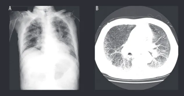 Fig. 1   Radiography of the chest showing diffuse ground glass shadow （A）and computed tomography 
