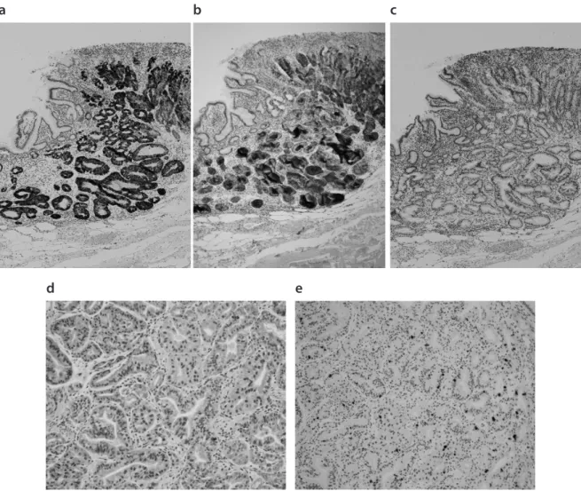Fig. 7.   Immunohistochemistry Demonstrated That the Neoplastic Glands Were Diffusely Reactive for MUC6 (a) and  Pepsinogen- I  (b), Nonreactive for MUC2 (c) and MUC5AC (d), and Low Labeling Index of Ki-67 (e)