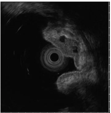 Fig. 9.   Endoscopic Ultrasonography (EUS) Findings Show  Isoechoic Tumor with Several Small Echo Free Spaces  in the Third Layer