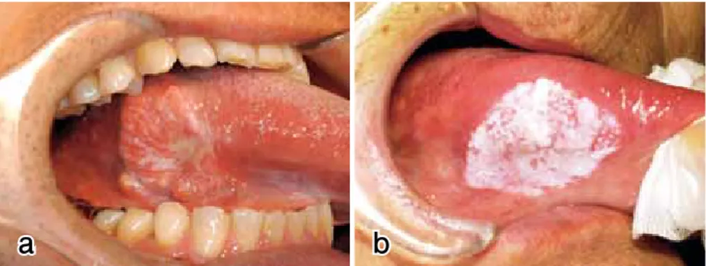 Fig. 1. Two different types of squamous cell carcinoma of the tongue: de novo type (a) and  sequential type (b)