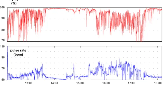 Fig. 1.   Continuous oxygen saturation monitoring during daily activities in a 70-year-old man with  ILD.9080SpO2(%) pulse rate(bpm)70100110907050 13:00 14:00 15:00 16:00 17:00 18:00