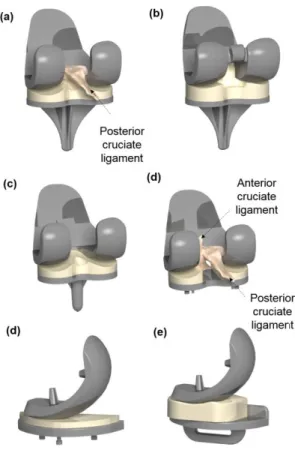 Fig. 3 Various types of TKA and UKA: (a) Fixed CR-TKA; (b) Fixed PS-TKA; (c) Mobile-bearing TKA; (d) Fixed UKA; 