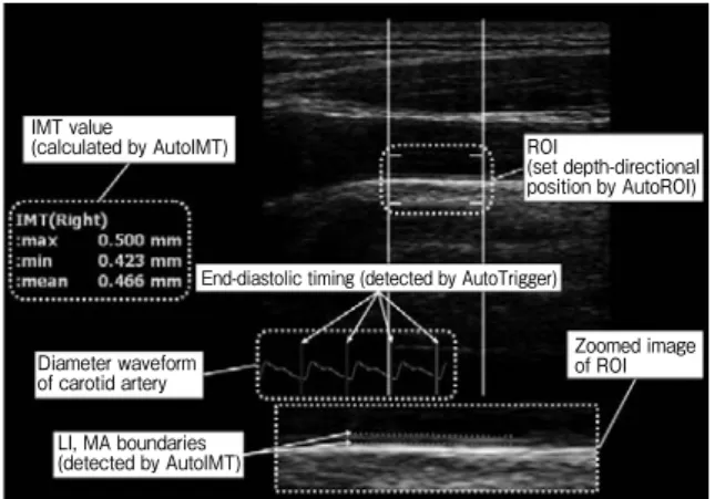 Fig. 6   Typical example of carotid IMT measurement with prototype systemEnd-diastolic timing (detected by AutoTrigger)