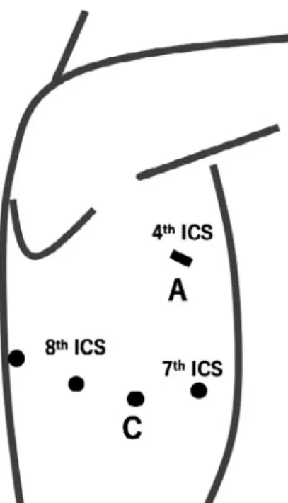 Figure   2   Schematic illustration of four port incisions and a  4-cm utility thoracotomy as an assistant port.