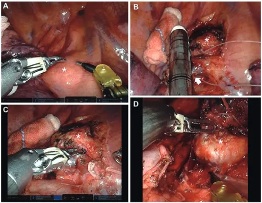 Figure   3   The intraoperative screenshot of the robot-assisted thoracoscopic surgery (RATS).